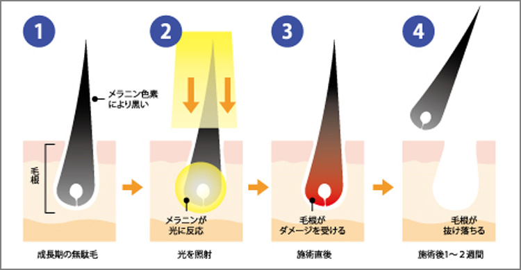メンズ脱毛専門店 ムッシュ KANAZAWA(金沢) SHR脱毛